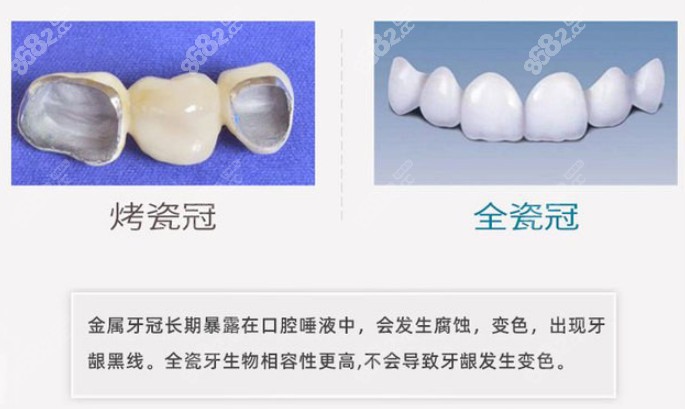 烤瓷牙冠和全瓷牙套的区别了解下