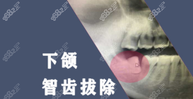 天津拔下颌智齿价格