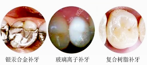 补牙材料都有哪些