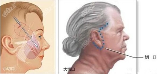 福州拉皮手術(shù)要多少錢