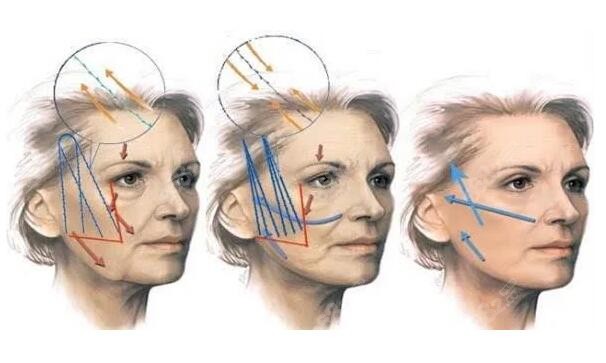 人工韧带面部提升手术原理