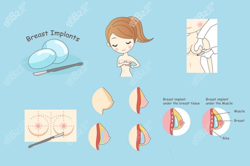 假体隆胸过程介绍