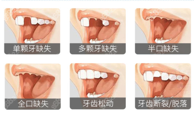 暨大口腔赖仁发医生种植牙价格