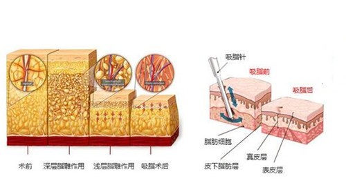 全身吸脂的原理