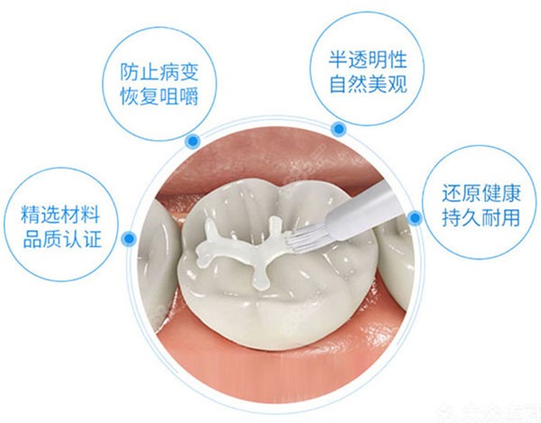 树脂补牙的特点