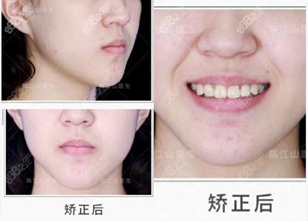 <!--<i data=20240705-sp></i>-->齿科陈江山矫正例子