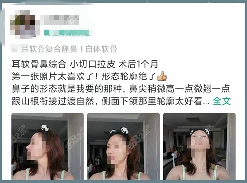 北京俊泰美好薛志强隆鼻口碑好