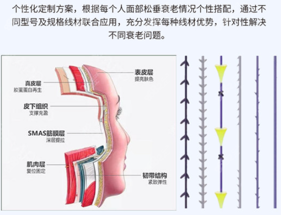 面部埋线提升的优势