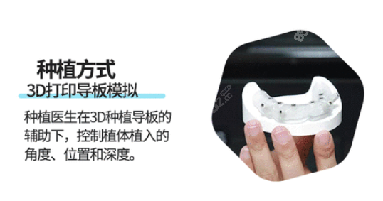 赖仁发做种植牙好吗