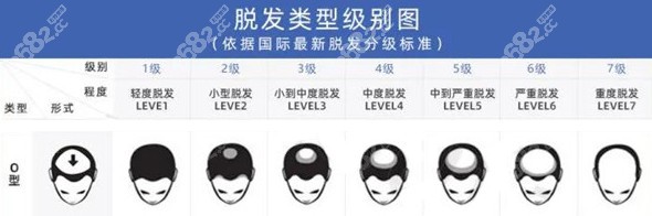 O型脱发的7种程度