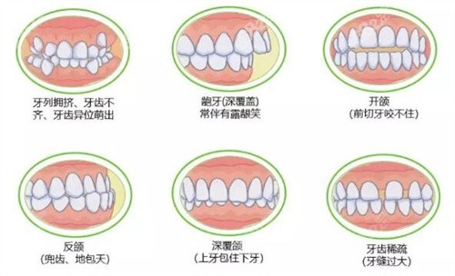 牙齿畸形各类情况