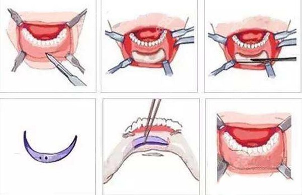 做假体垫下巴手术的原理图