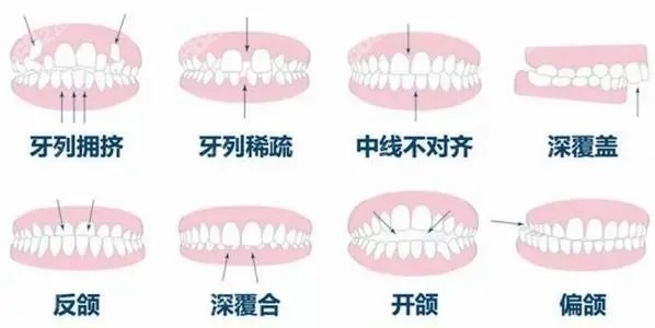 烟台可以矫正的牙齿类型