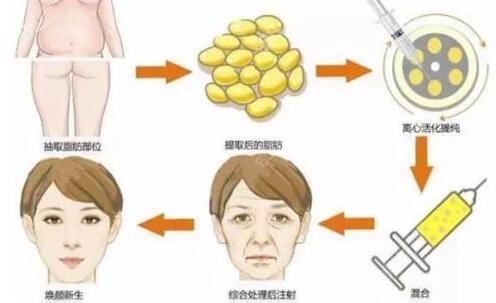 长沙做吸脂哪个医生靠谱