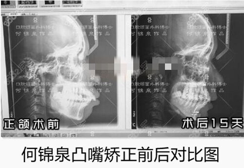 廣大整形何錦泉凸嘴正頜前后對(duì)比圖