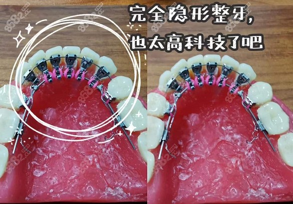 舌侧隐形牙套示意图