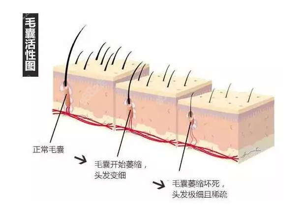 做详细的毛囊检测才能知道自己的头发状况