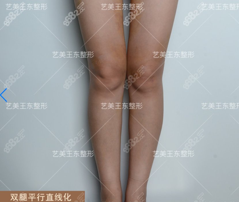 王东双腿吸脂术后范例
