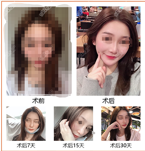 上海薇琳的曹芳医生做的鼻子