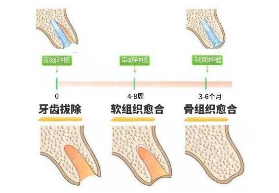 即刻种植和常规种植区别