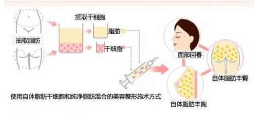 温州自体脂隆胸哪家医院好呀？