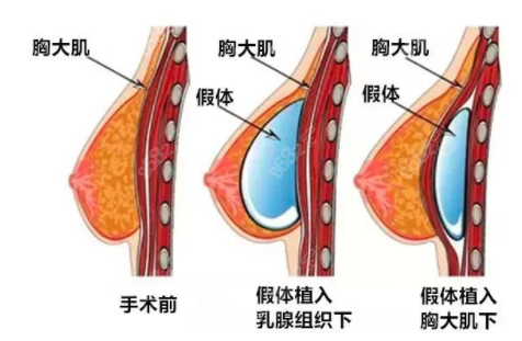 温州隆胸哪个医院好呀？