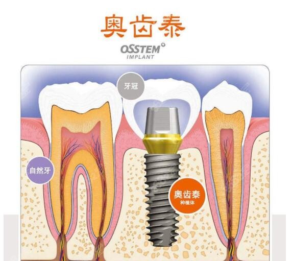 韩国奥齿泰种植体公司