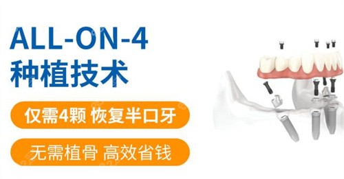 广州穗华口腔半口种植
