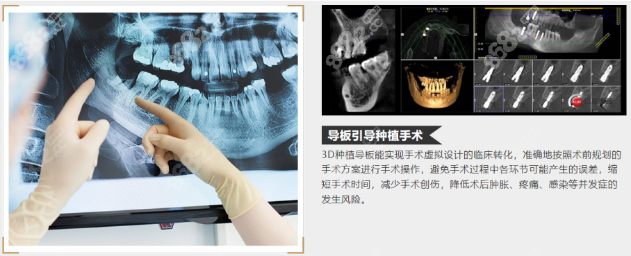 重庆地区德亚口腔种植牙技术
