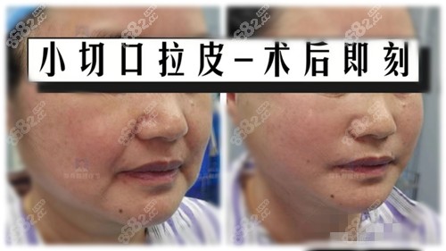 广州南方医科大学珠江医院小切口拉皮手术对比图