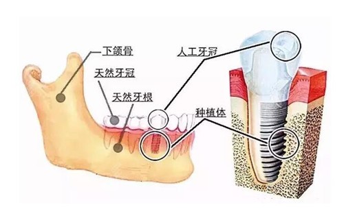 种植牙技术