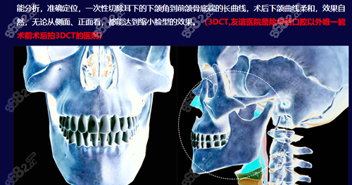 四川友谊医院做下颌角磨骨手术采用的3d数字化技术