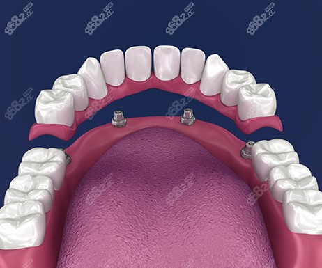 老年人做满口种植牙的价格及技术名称