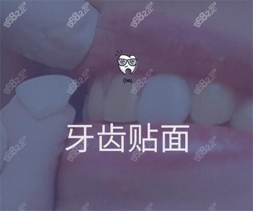 上海华美齿科牙齿贴面