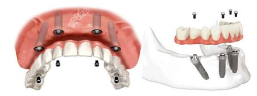 哈尔滨做全口种植牙过程