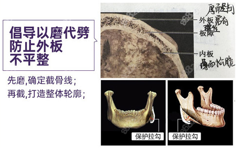 潘宝华下颌角截骨优势