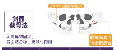 潘宝华颧骨整形优势