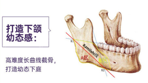 潘宝华下颌角截骨优势