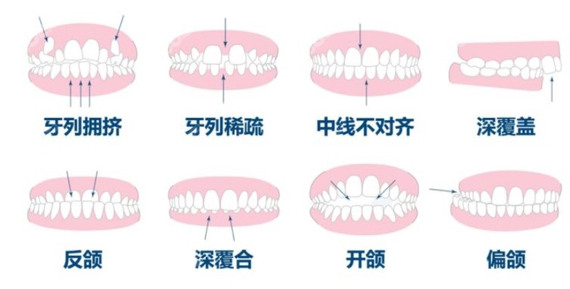 牙齿矫正的适应症