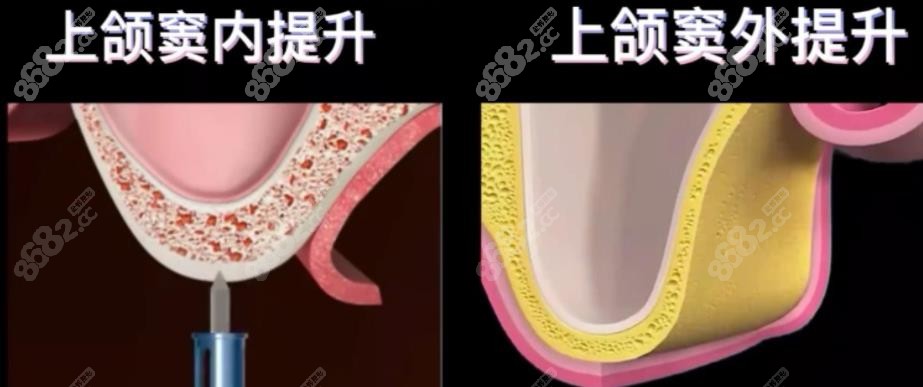 上颌窦内外提升区别