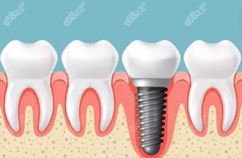 南通做种植牙医院哪家好