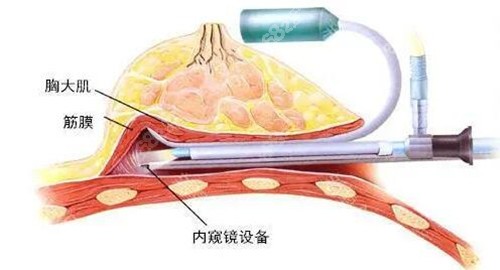 内窥镜隆胸