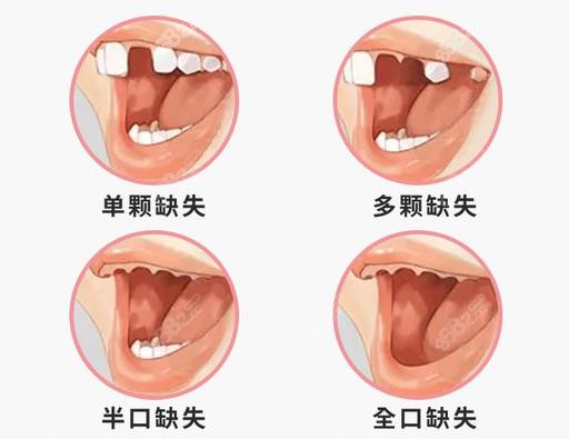 杭州薇琳种植牙适应人群