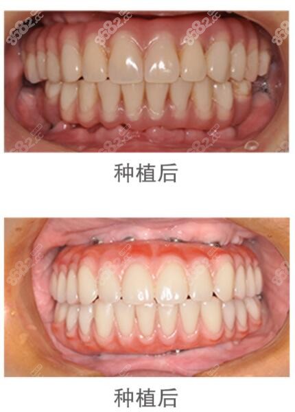慈溪鼎植口腔门诊部种植牙术后