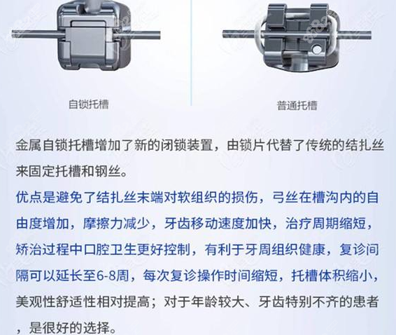 自锁托槽和普通托槽矫正的优缺点对比