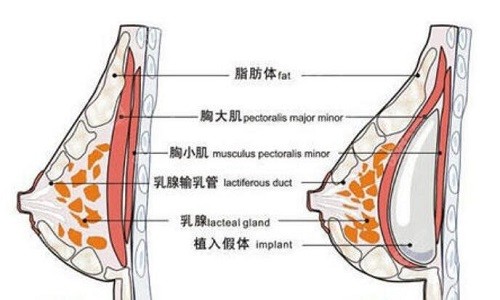 深圳美莱郭杰隆胸