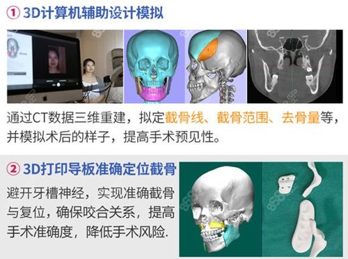 广大医院3D导板技术