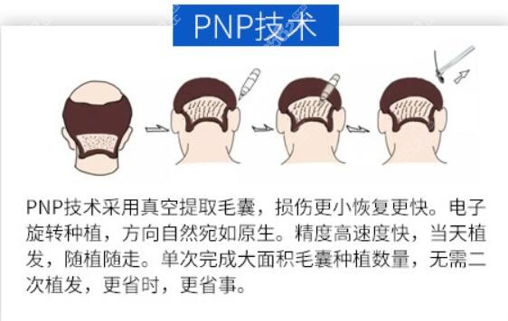 沈阳华美植发中心pnp植发技术