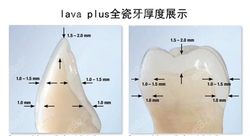 3M lava plus牙冠厚度展示