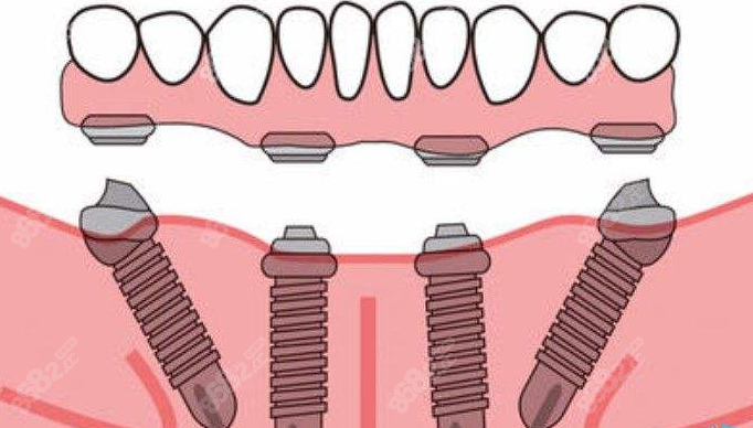 all-on-4种植牙技术
